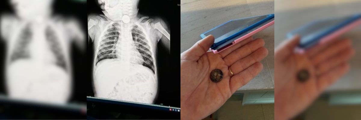 Bebê é internado após engolir bateria de brinquedo em Goiás