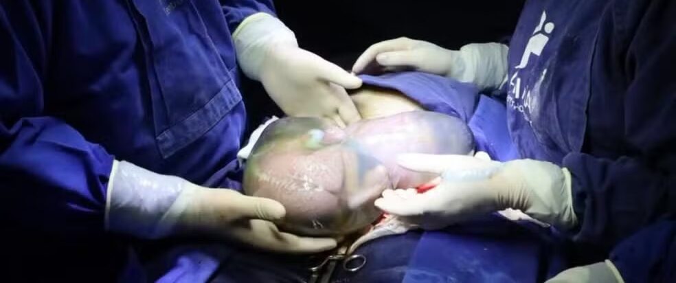 Parto raro de trigêmeos emociona equipe médica com nascimento de dois deles empelicados em Anápolis