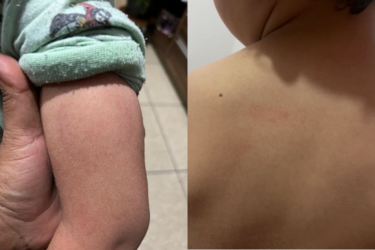 Criança de 3 anos apresenta hematomas em berçário de Goiânia