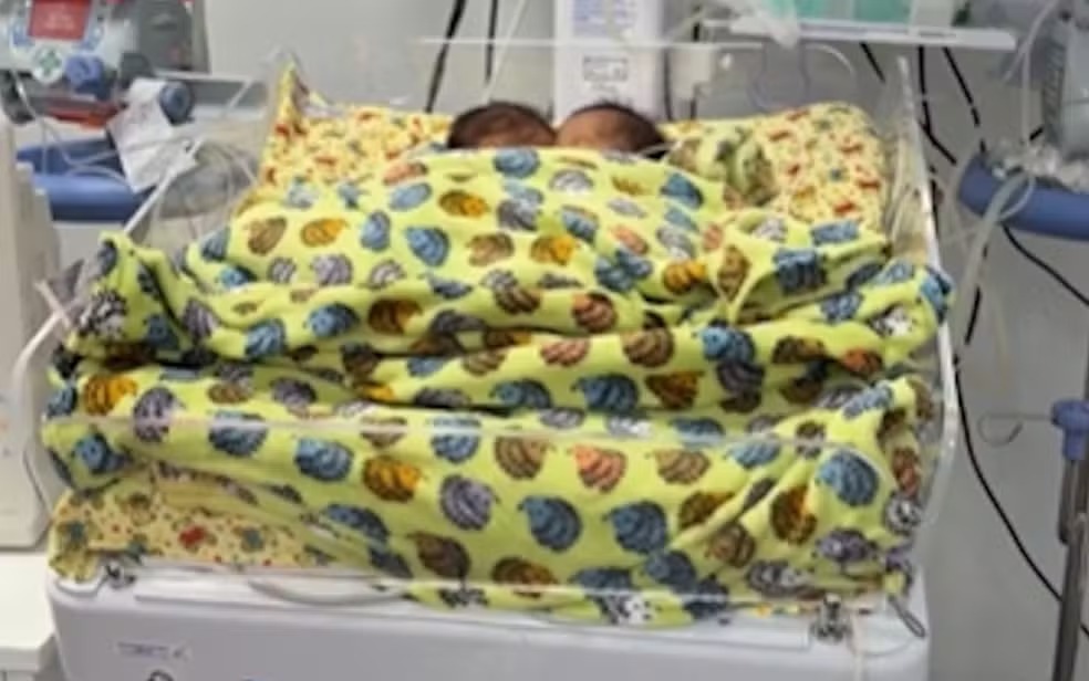 Gêmeos siameses Bernardo e Eduardo morrem dias antes de cirurgia de separação em Goiânia