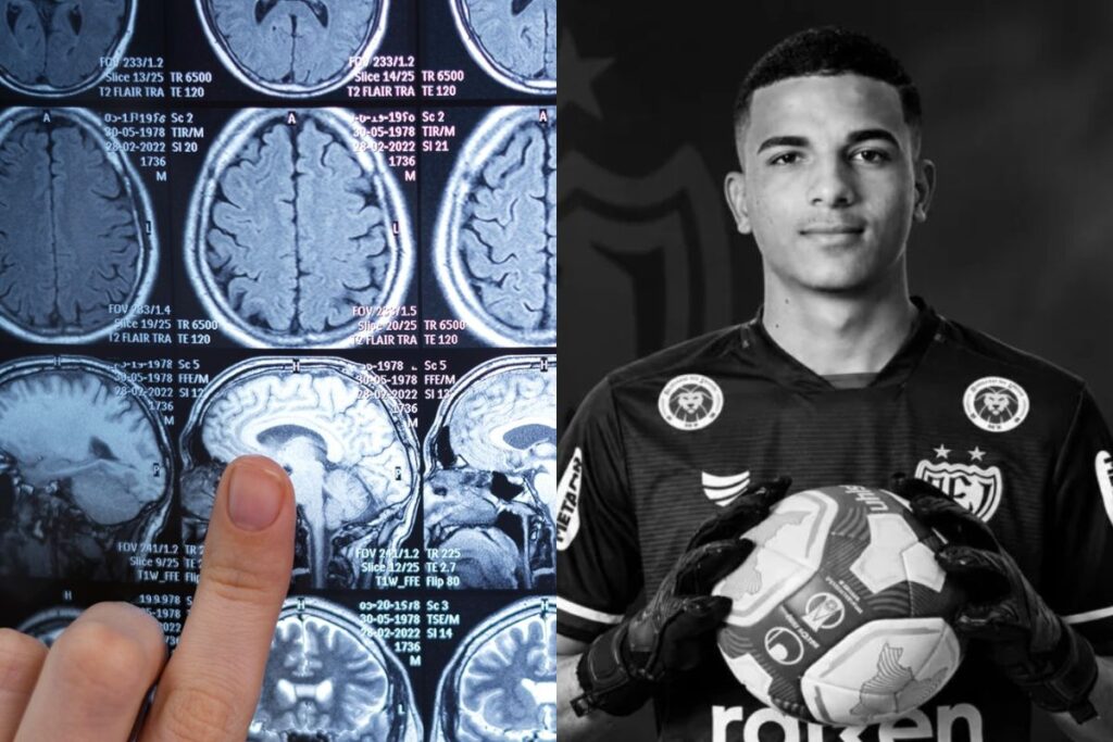 AVC em jovens: morte de goleiro de 23 anos acende alerta sobre sinais e prevenção