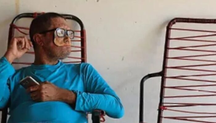 Imagem mostra pessoa com Xeroderma Pigmentoso. (Foto: Sociedade Brasileira de Dermatologia (SBD)/Divulgação)