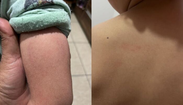 Criança de 3 anos apresenta hematomas em berçário de Goiânia