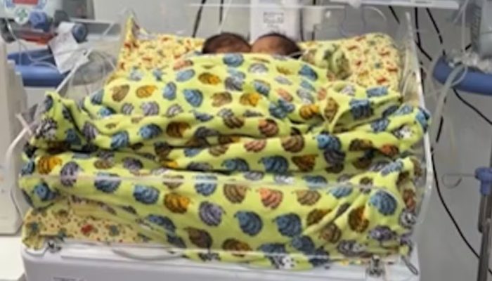 Gêmeos siameses Bernardo e Eduardo morrem dias antes de cirurgia de separação em Goiânia
