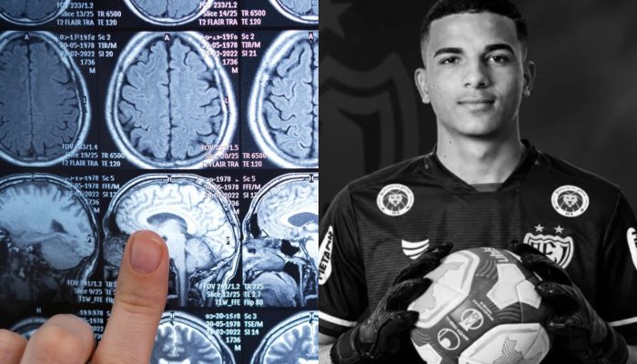 AVC em jovens: morte de goleiro de 23 anos acende alerta sobre sinais e prevenção