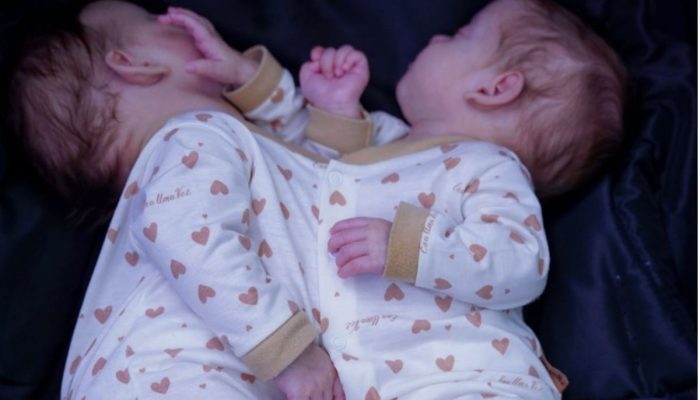 Gêmeas unidas pelo abdômen iniciam preparação para cirurgia de separação, em Goiânia